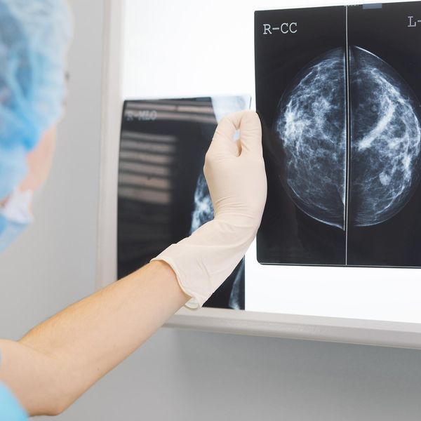 doctor holding a mammogram in front of x-ray illuminator