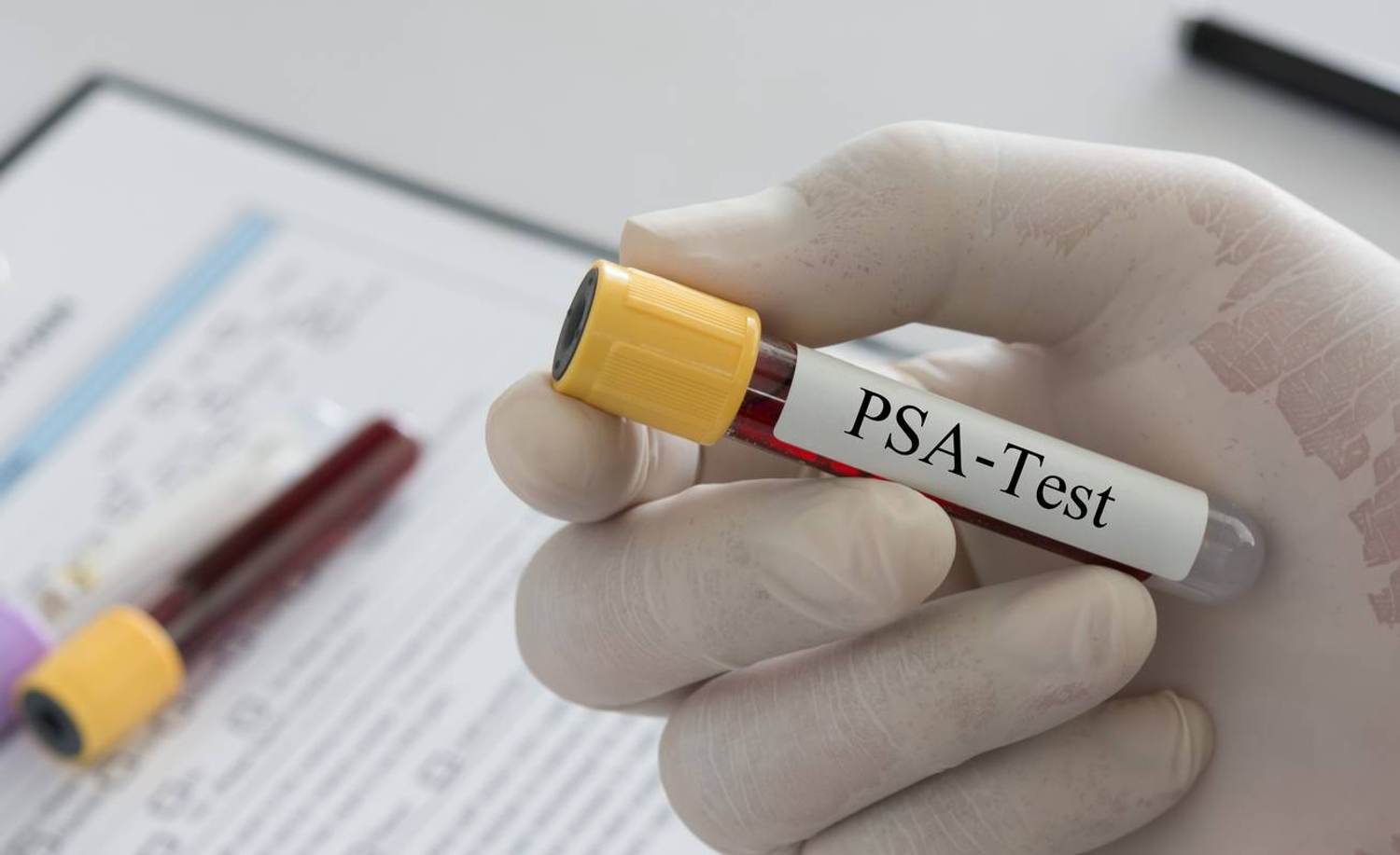 Have a Male Partner? Here’s What You Need to Know About Prostate Cancer