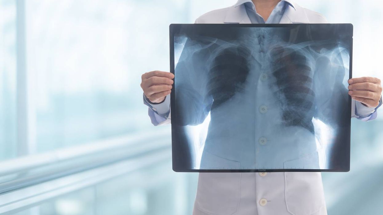 Doctor radiology looking chest or lung x-ray images at hospital ward to diagnose lung cancer