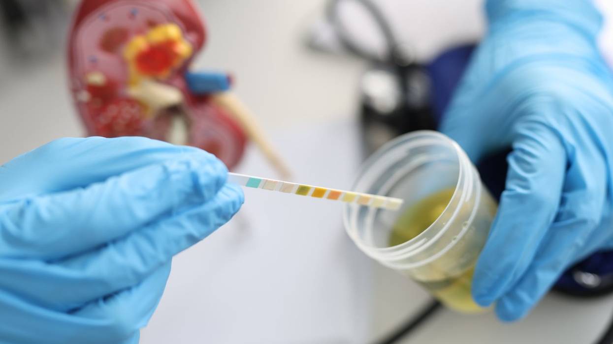 Doctor urologist making express urine test using indicator paper closeup