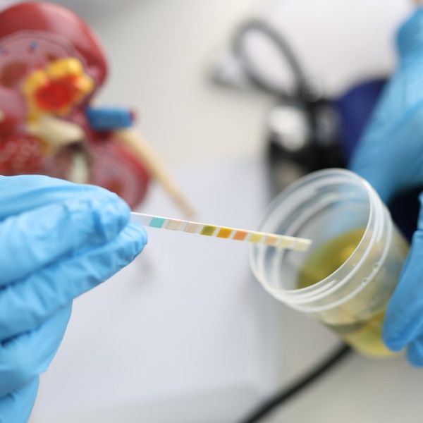 Doctor urologist making express urine test using indicator paper closeup