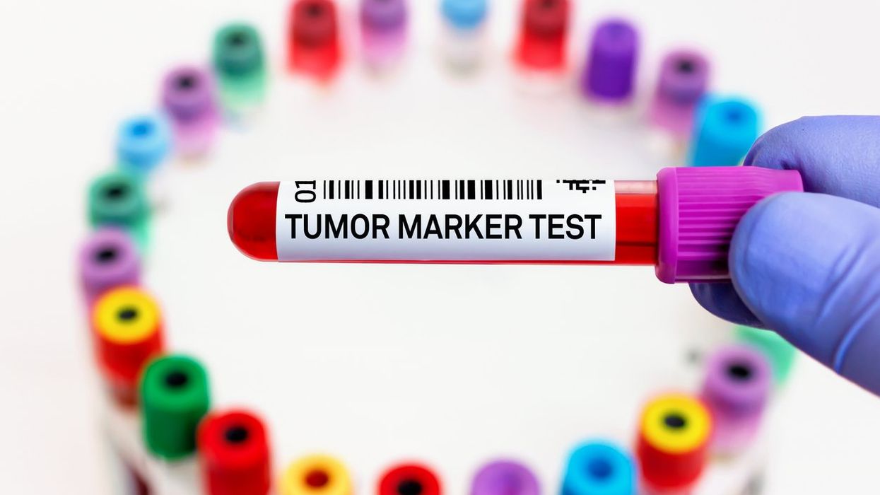 Doctor with blood tube labeled with Tumor marker for analysis of cancer biomarkers test
