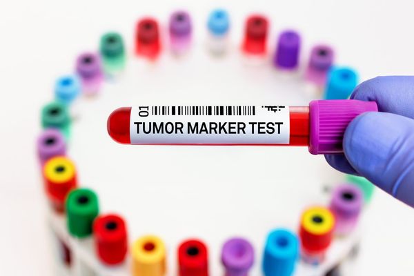 Doctor with blood tube labeled with Tumor marker for analysis of cancer biomarkers test