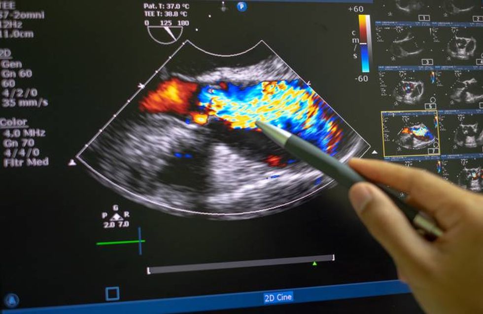 Echocardiography (ultrasound)