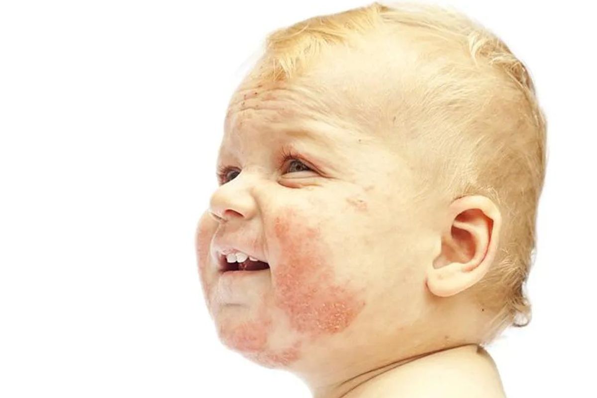 Eczema's Effects More Than Skin Deep