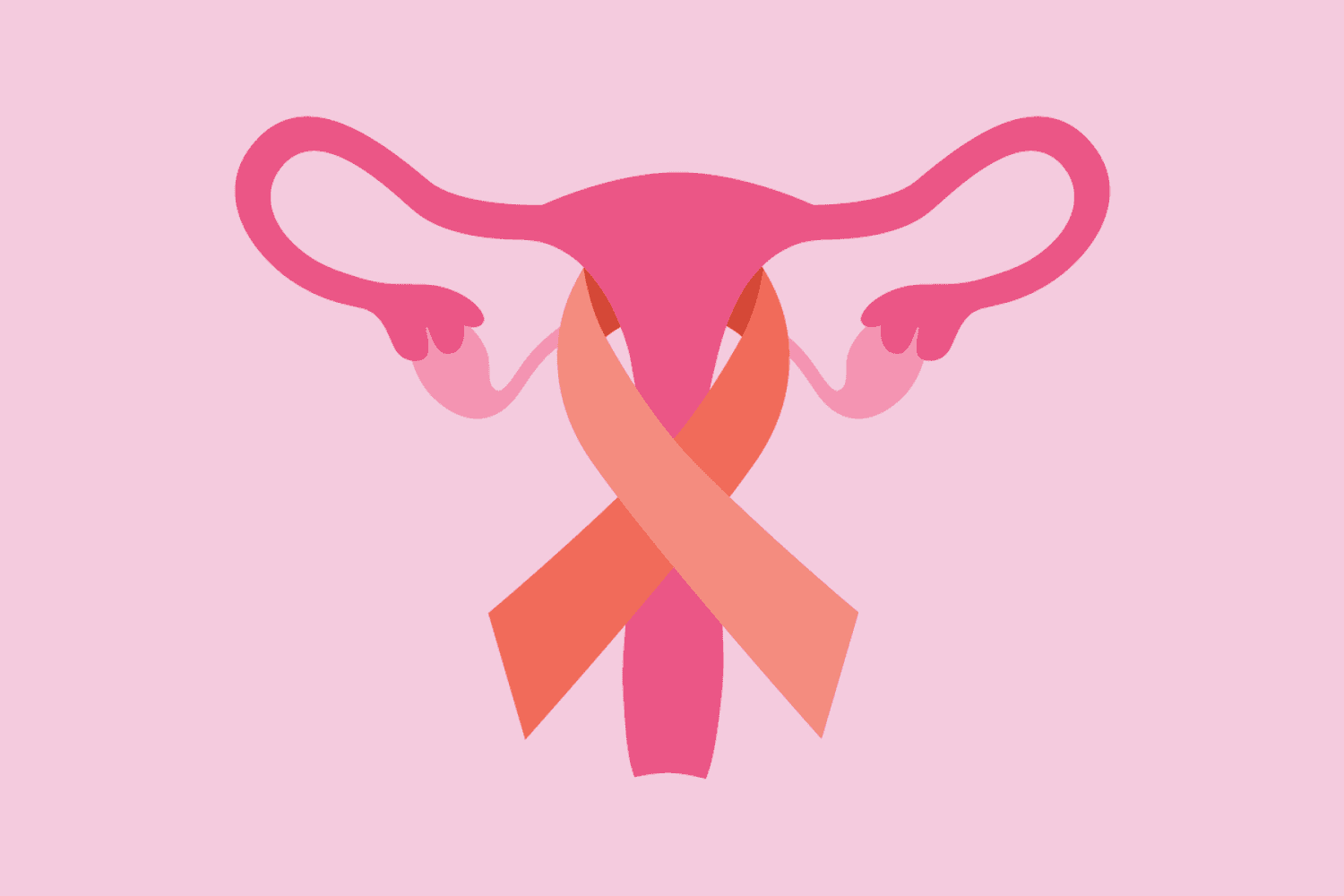 Endometrial Cancer Testing and Diagnosis