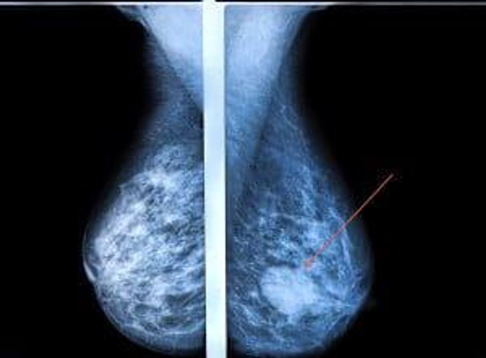 3 Facts Every Woman Needs To Know About Breast Cancer Screening