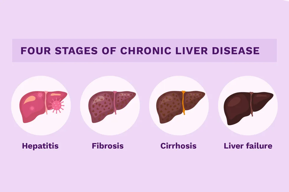 four stages of liver disease