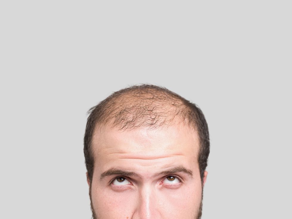 Geneticists Get to the Roots of Hair Loss in Men