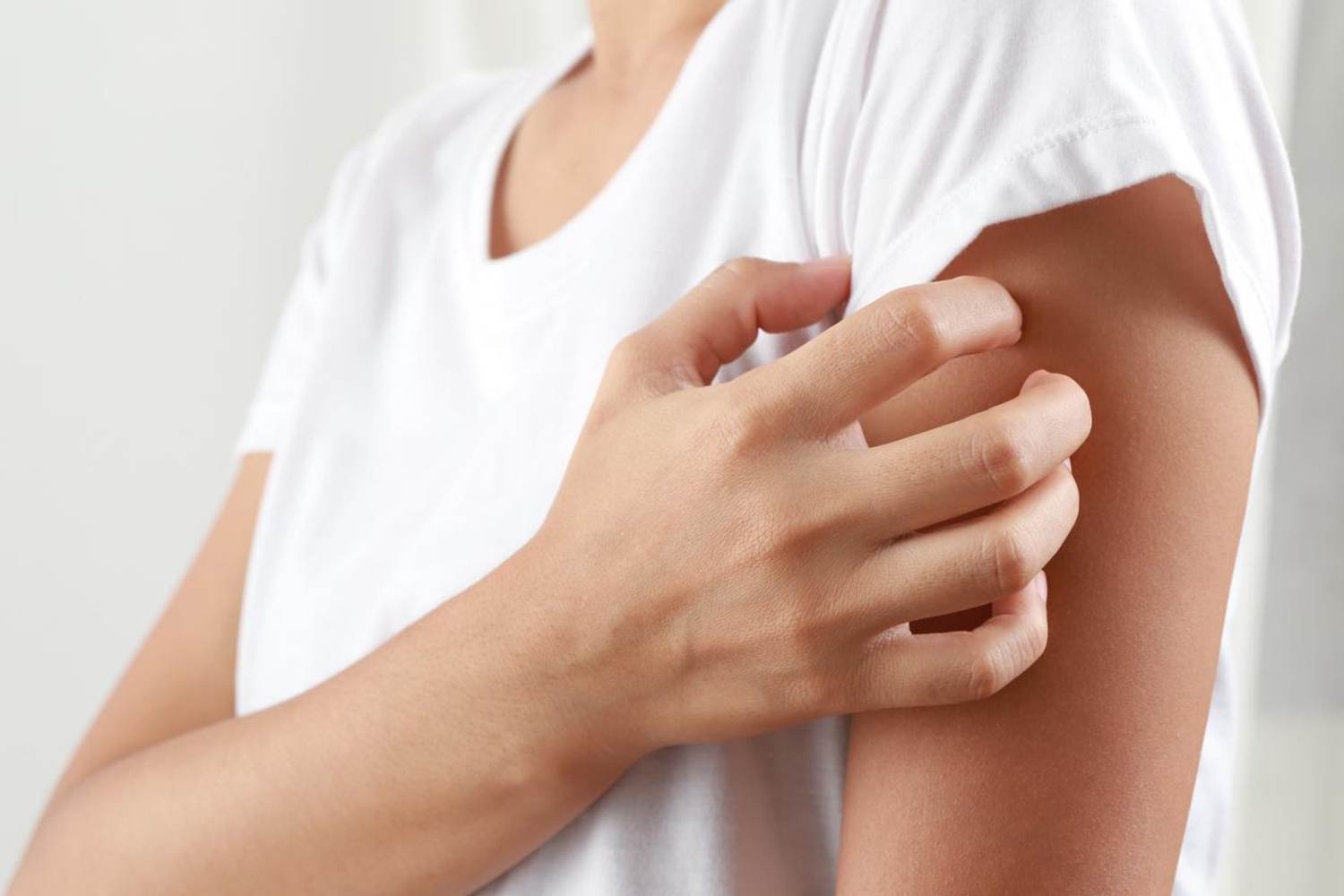 Shingles: What It Is and How to Prevent It