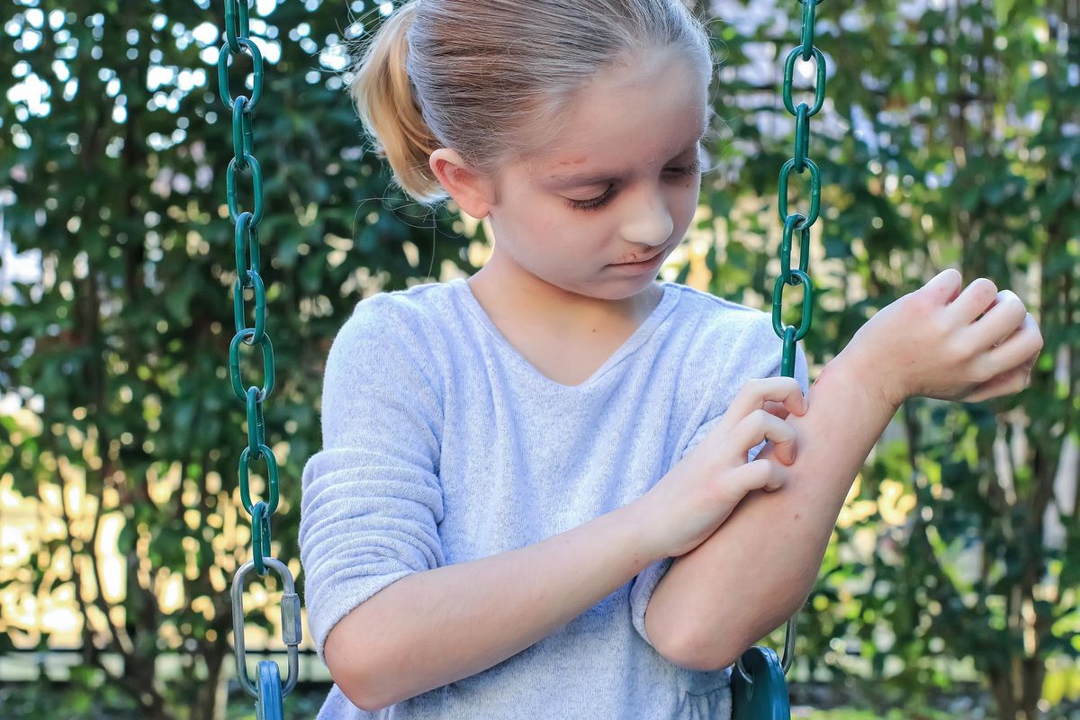 Girl With Eczema Scratching Her Arm
