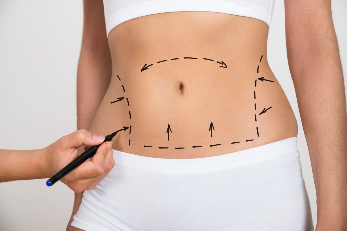 Hand Drawing Lines On A Woman's Abdomen As Marks For Abdominal Cellulite Correction