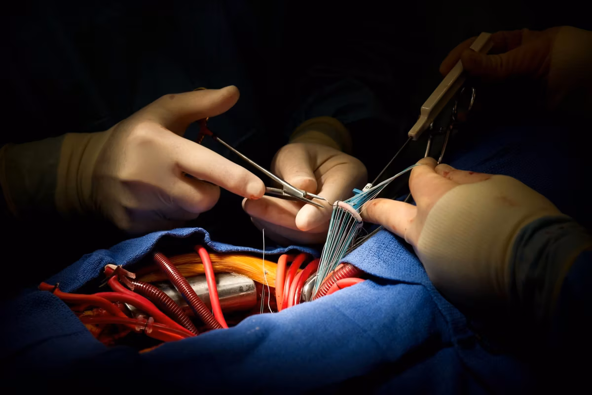 Heart Surgery Aortic Valve Replacement