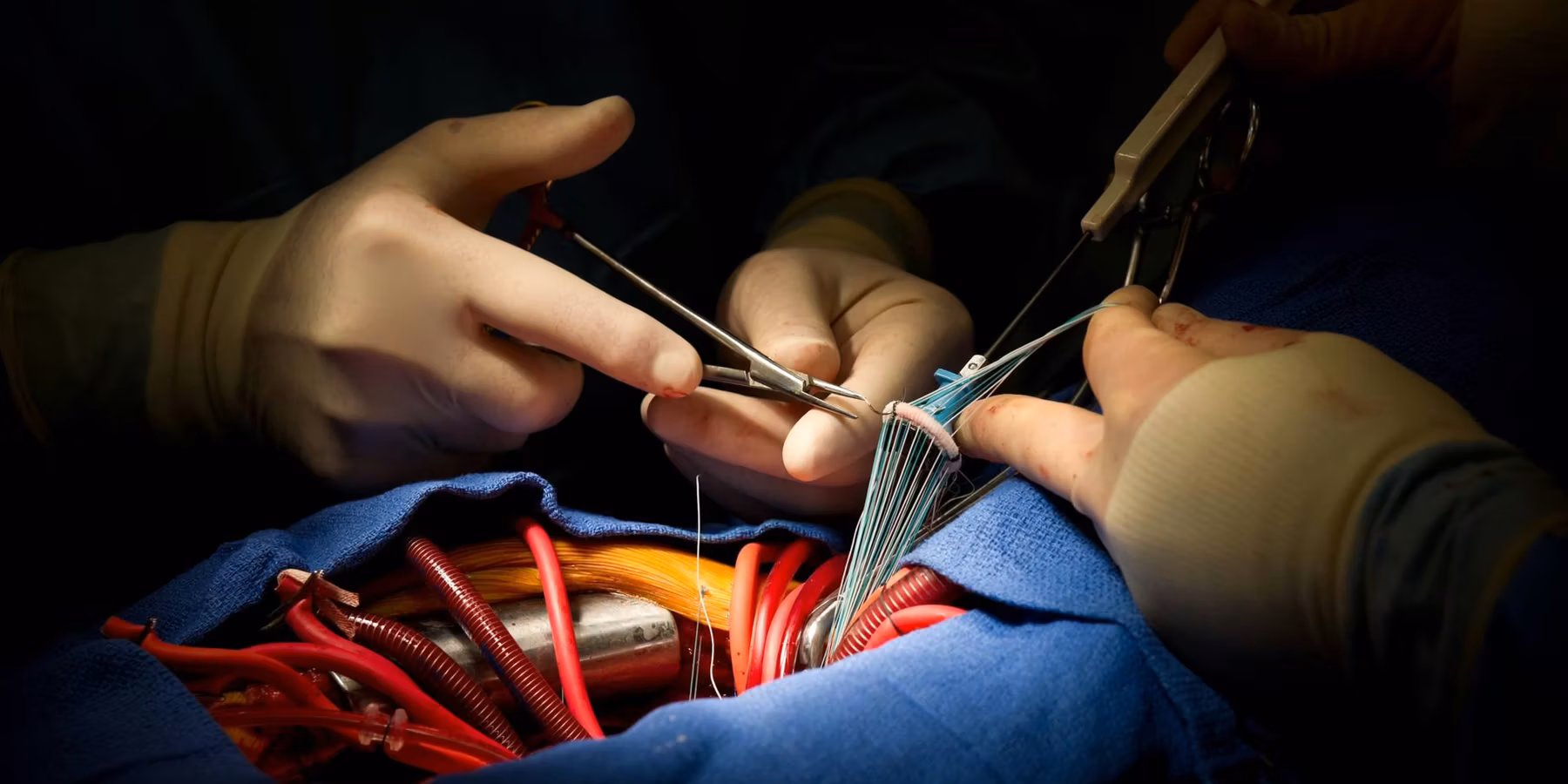 Heart Surgery Aortic Valve Replacement