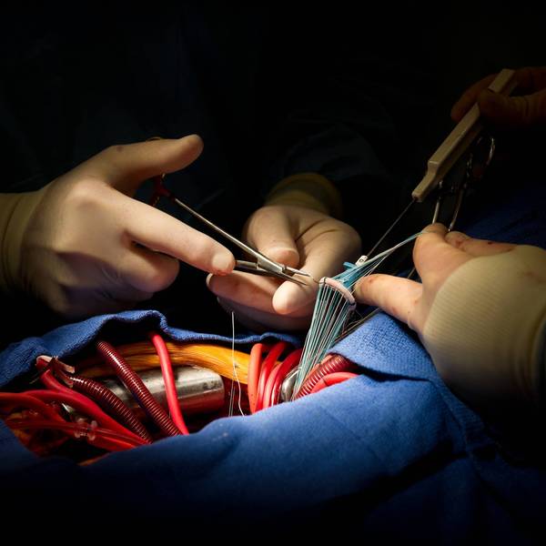 Heart Surgery Aortic Valve Replacement