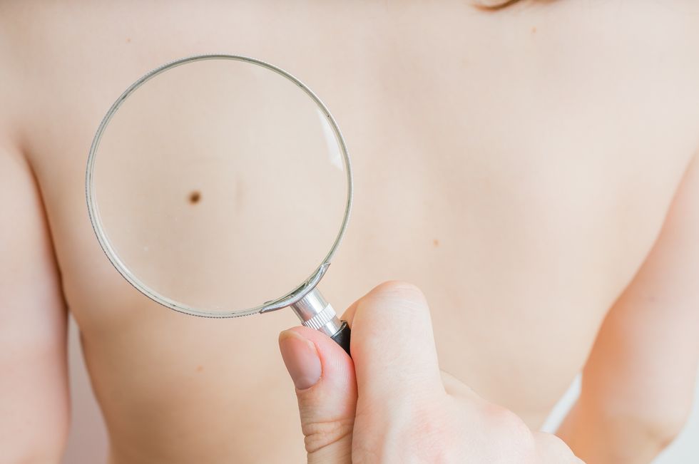 How to Do a Skin Cancer Body Check