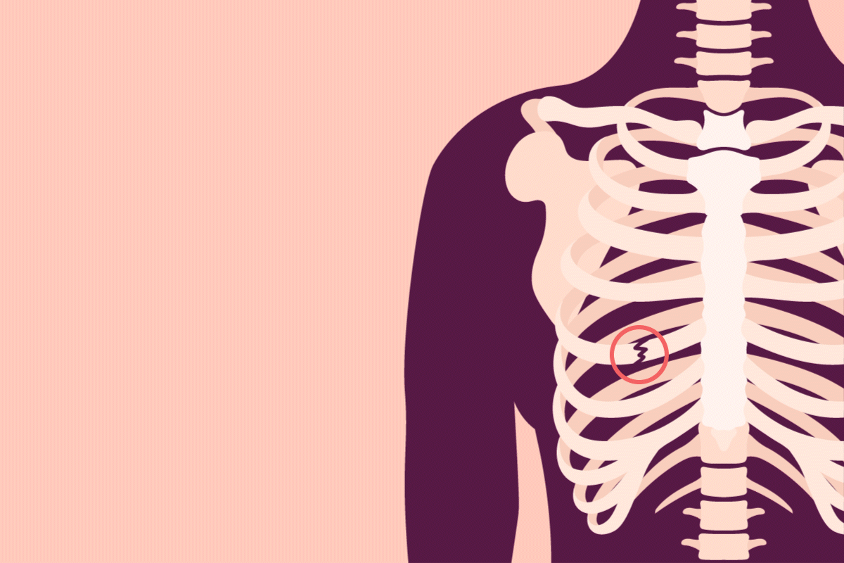 illustration of a broken rib