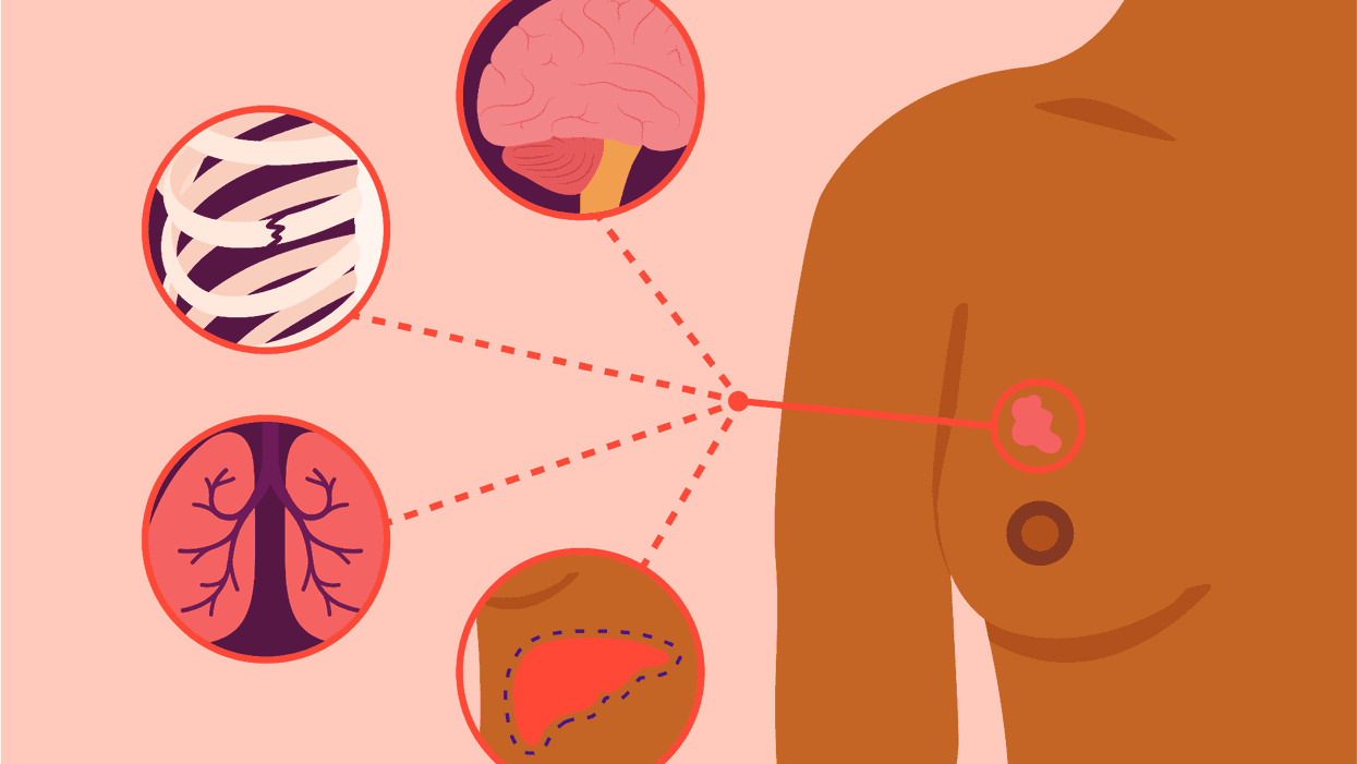 Where Metastatic Breast Cancer Can Spread in the Body