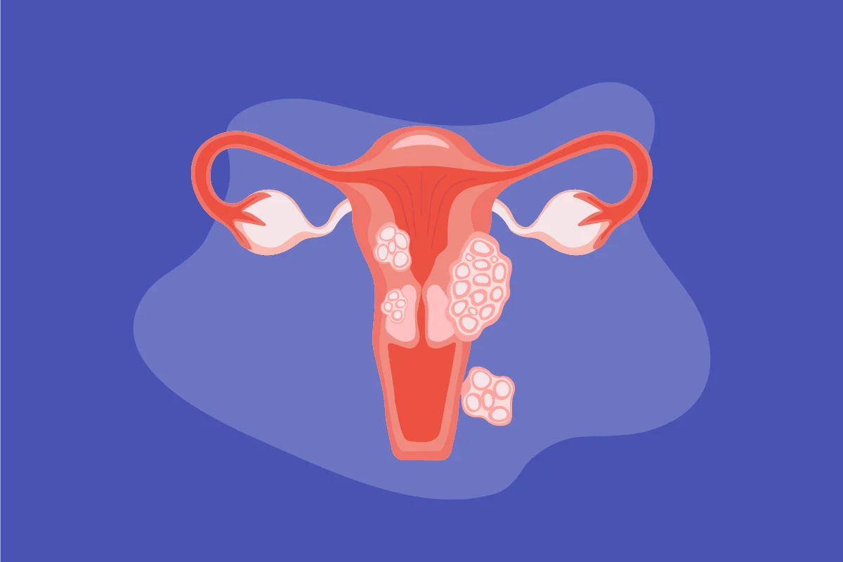 Illustration of w uterus with fibroids on a blue background