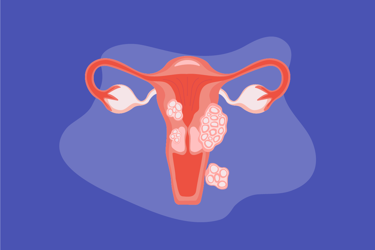 Illustration of w uterus with fibroids on a blue background