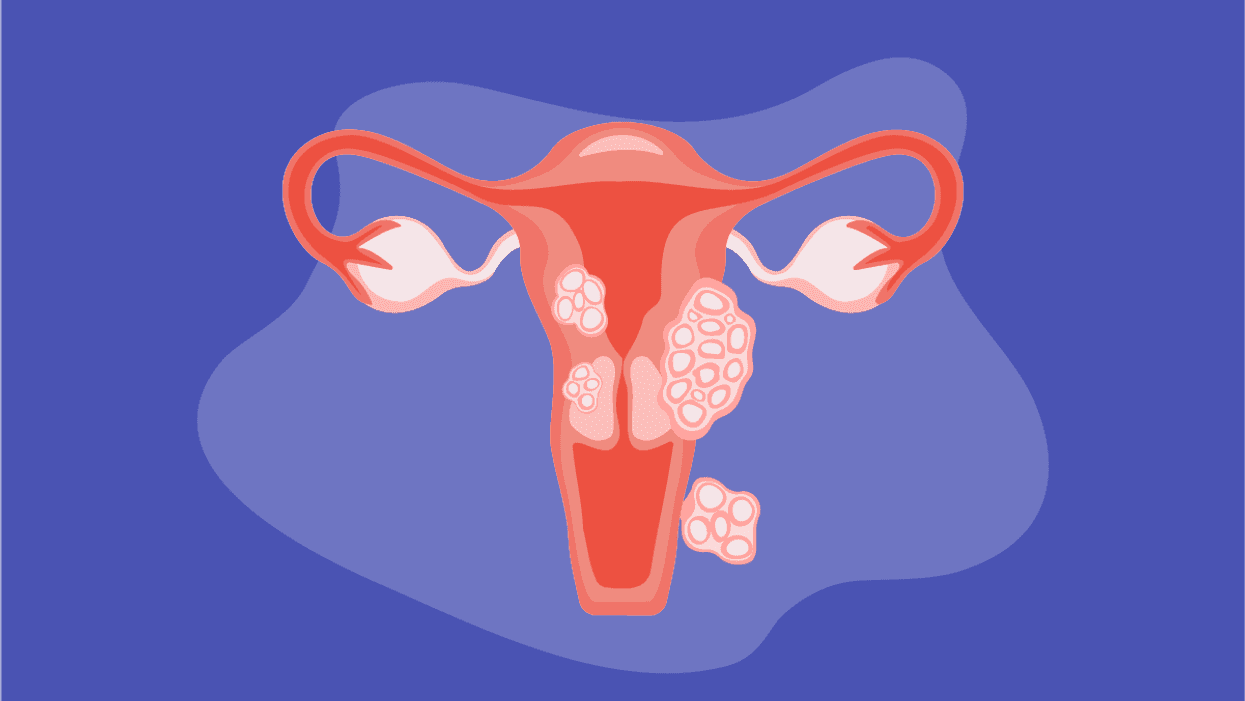 What You Need to Know About Uterine Fibroids