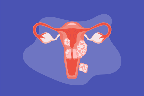 Illustration of w uterus with fibroids on a blue background