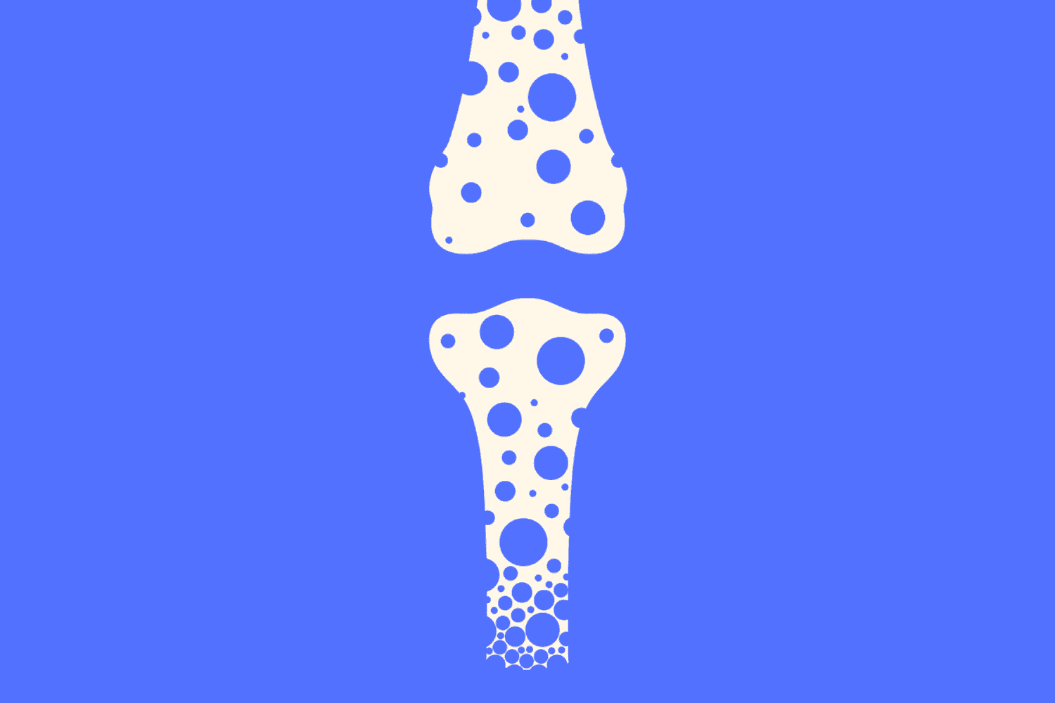 Are You at Risk for Osteoporosis?