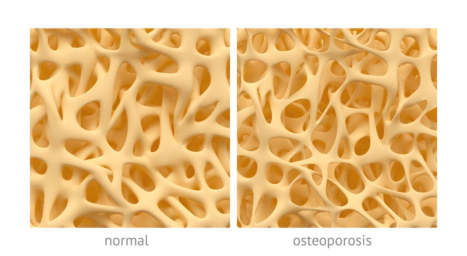 I Have Postmenopausal Osteoporosis: What I Wish I Had Known When I Was 40