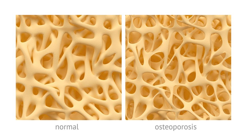 image of bone with osteoporosis