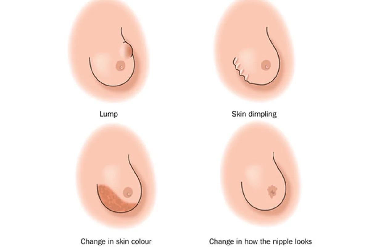 Finding a Lump or Other Change in Your Breasts