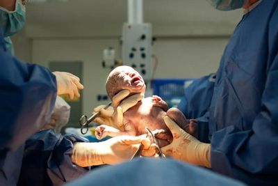 c-section birth