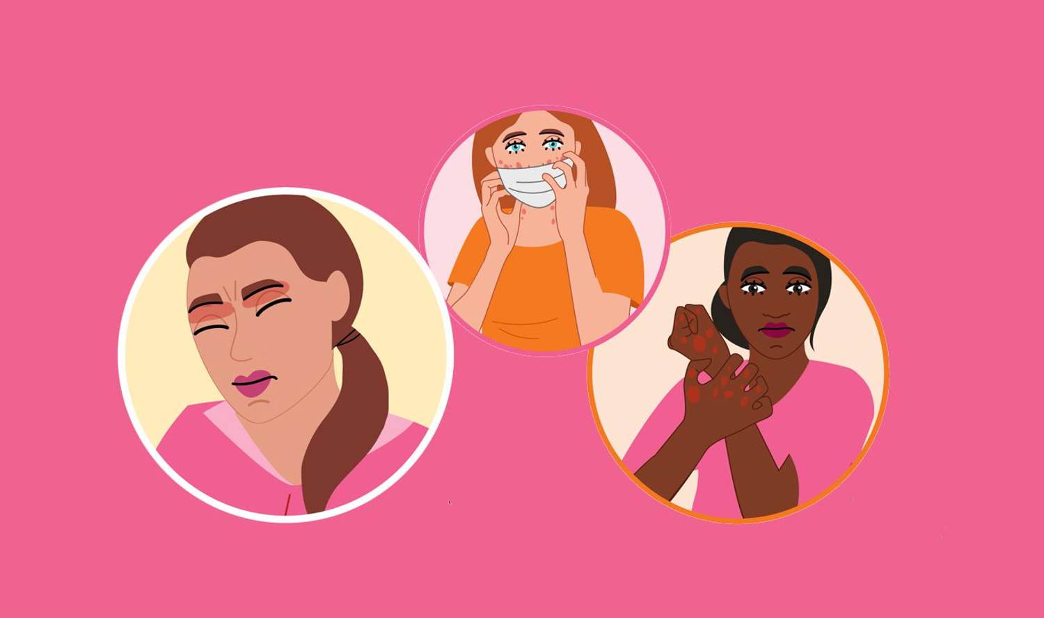 Coping With Atopic Dermatitis