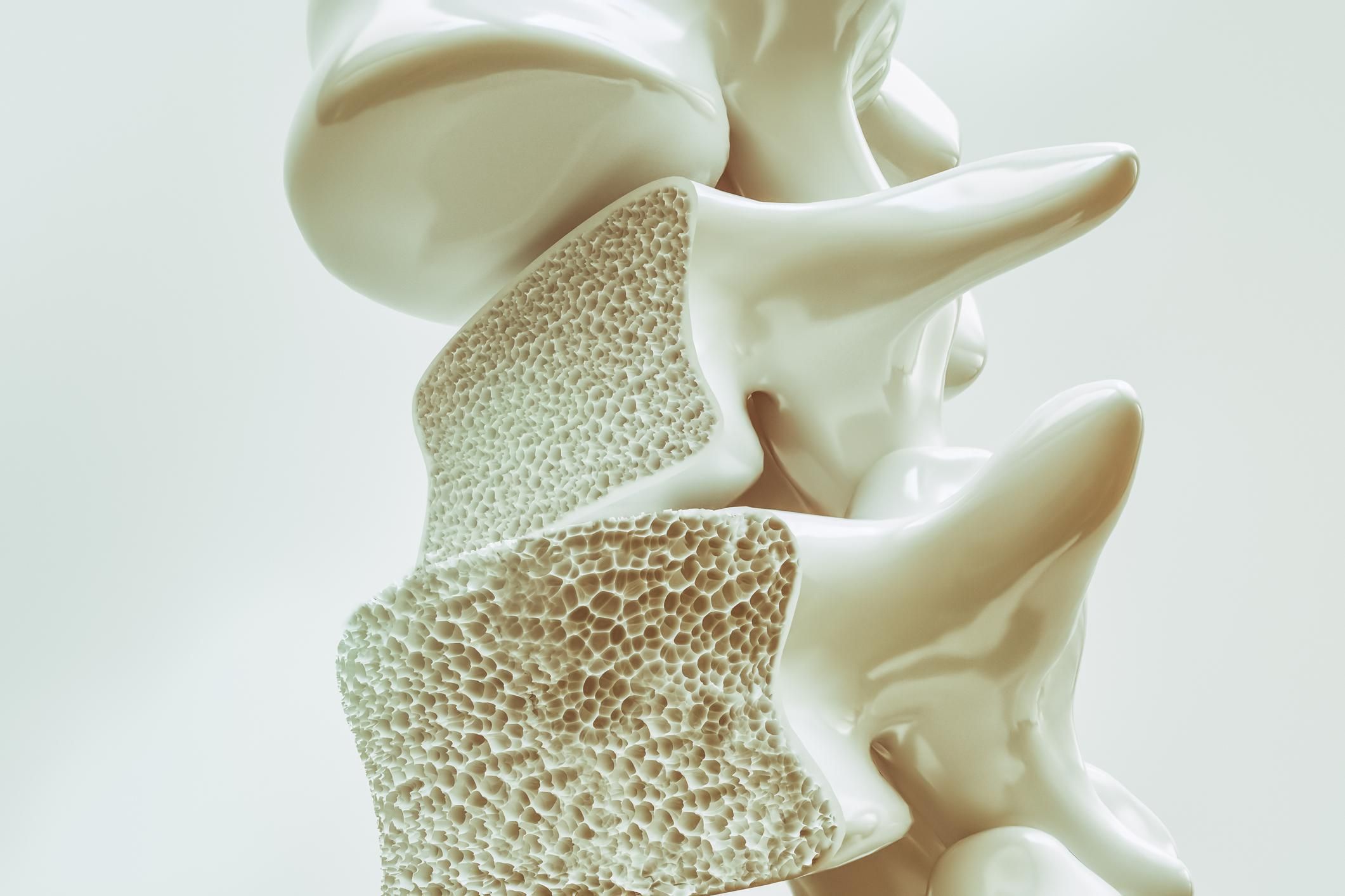 Osteoporosis on the spine 