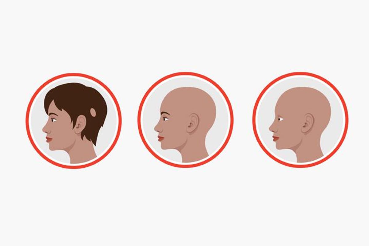 Alopecia Areata: Losing Your Hair? Don’t Despair