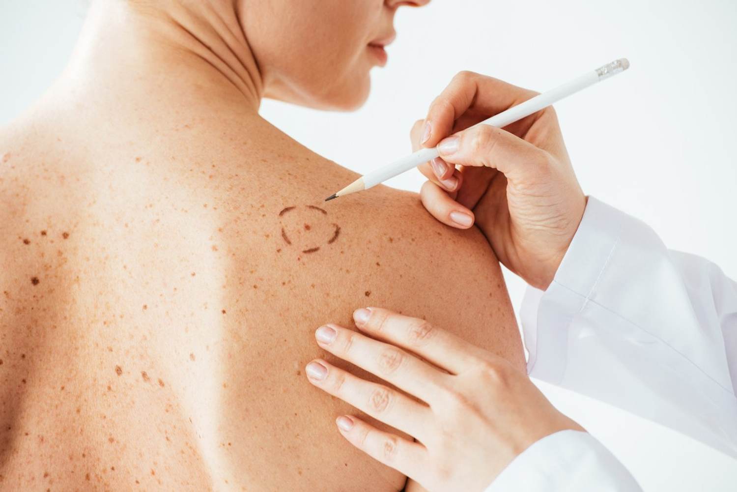 Skin Cancer