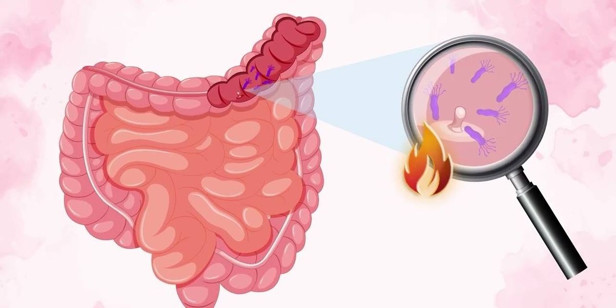 How Your Gut Microbiome Affects Your Colorectal Cancer Risk