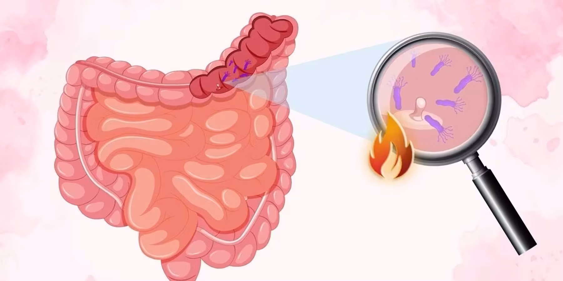 How Your Gut Microbiome Affects Your Colorectal Cancer Risk