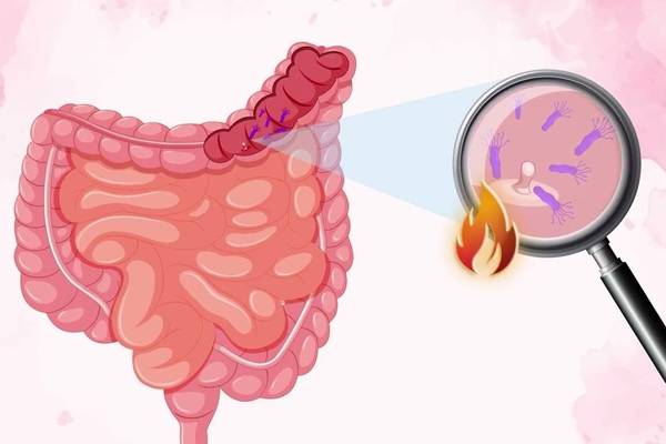 How Your Gut Microbiome Affects Your Colorectal Cancer Risk