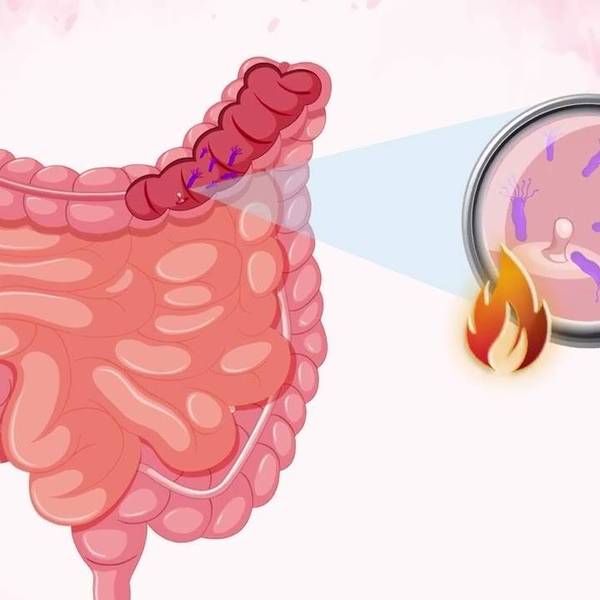 How Your Gut Microbiome Affects Your Colorectal Cancer Risk