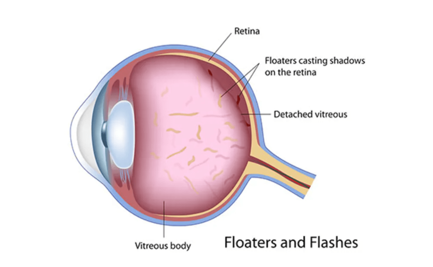 Do You Know the Symptoms of Retinal Detachment?