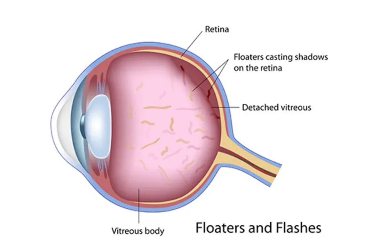 Do You Know the Symptoms of Retinal Detachment?