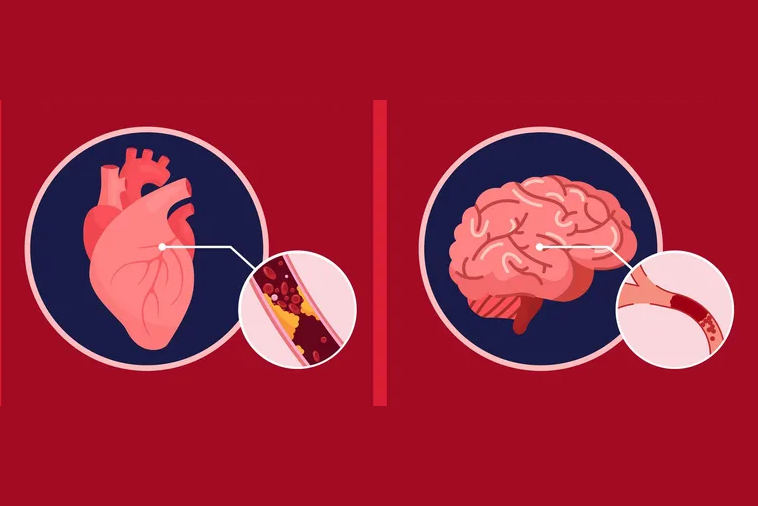 Stroke vs. Heart Attack: Know the Signs & Symptoms