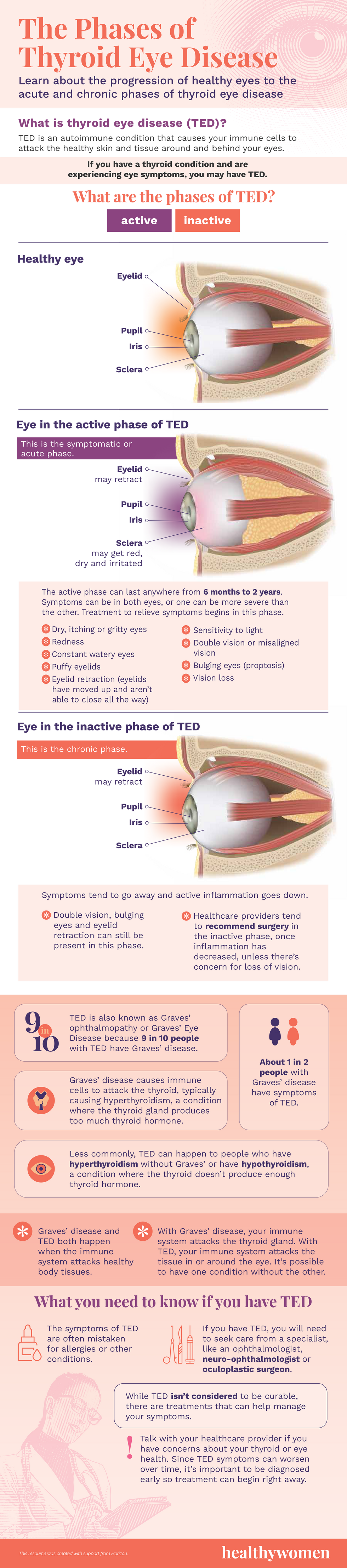 Infographic The Phases of Thyroid Eye Disease. Click the image to open the PDF