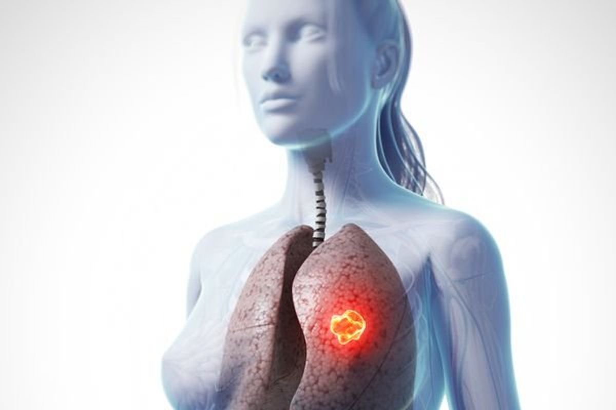 interior image of a woman with lung cancer