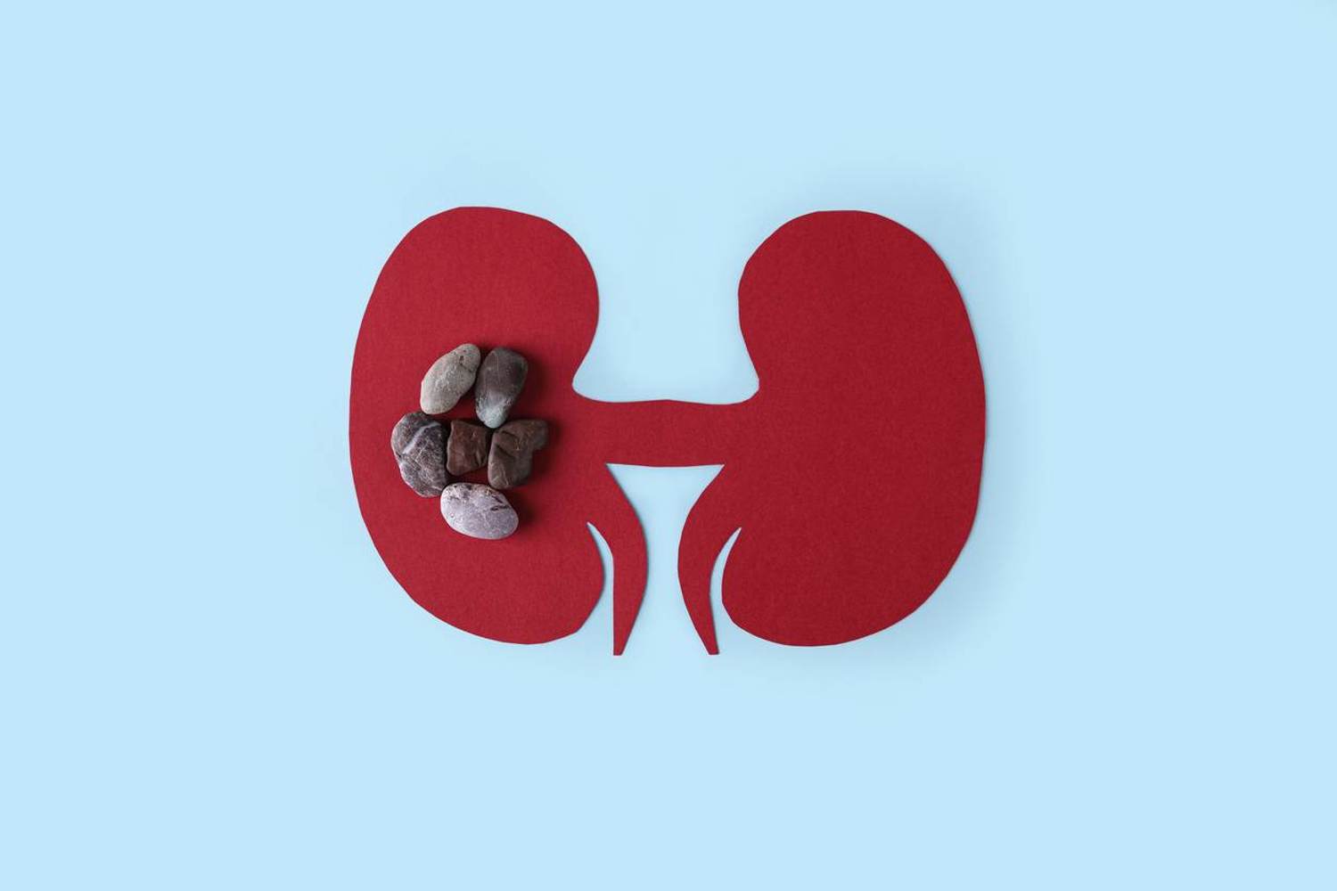 What Women Need to Know About Kidney Stones