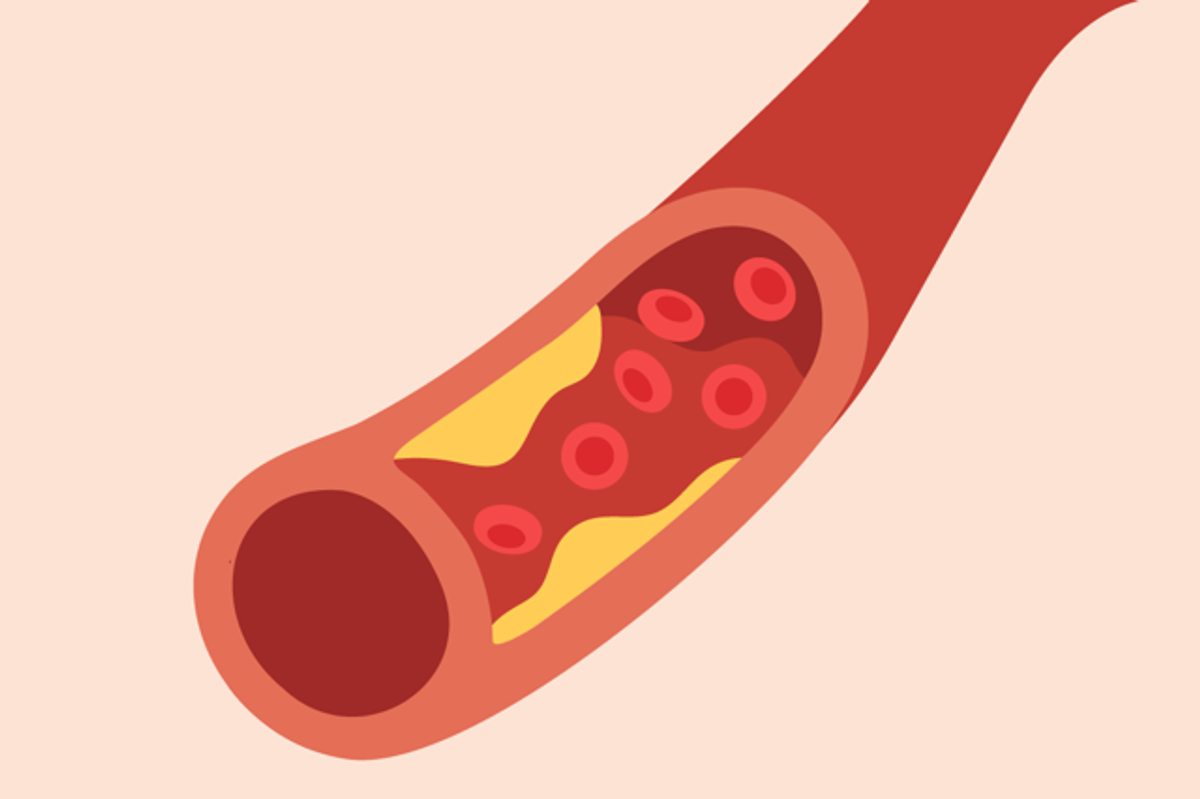La aterosclerosis y las enfermedades cardiacas