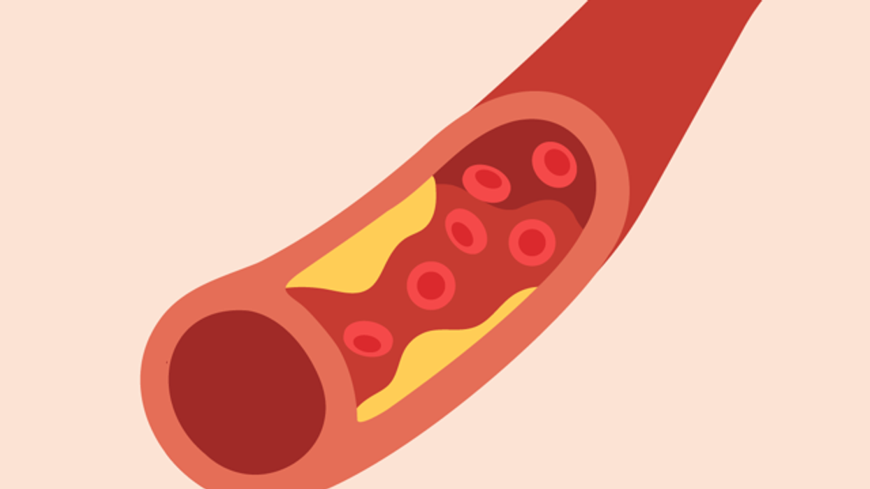 La aterosclerosis y las enfermedades cardiacas