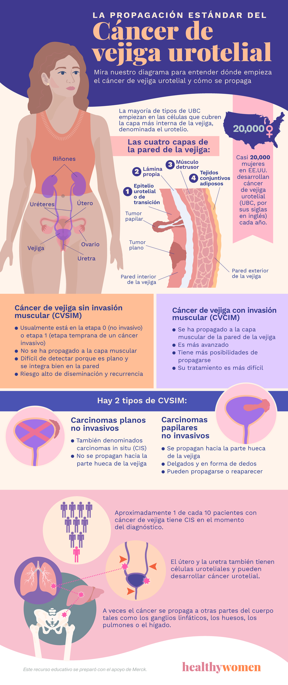 La propagaciu00f3n estu00e1ndar del cu00e1ncer de vejiga urotelial. Click to view PDF