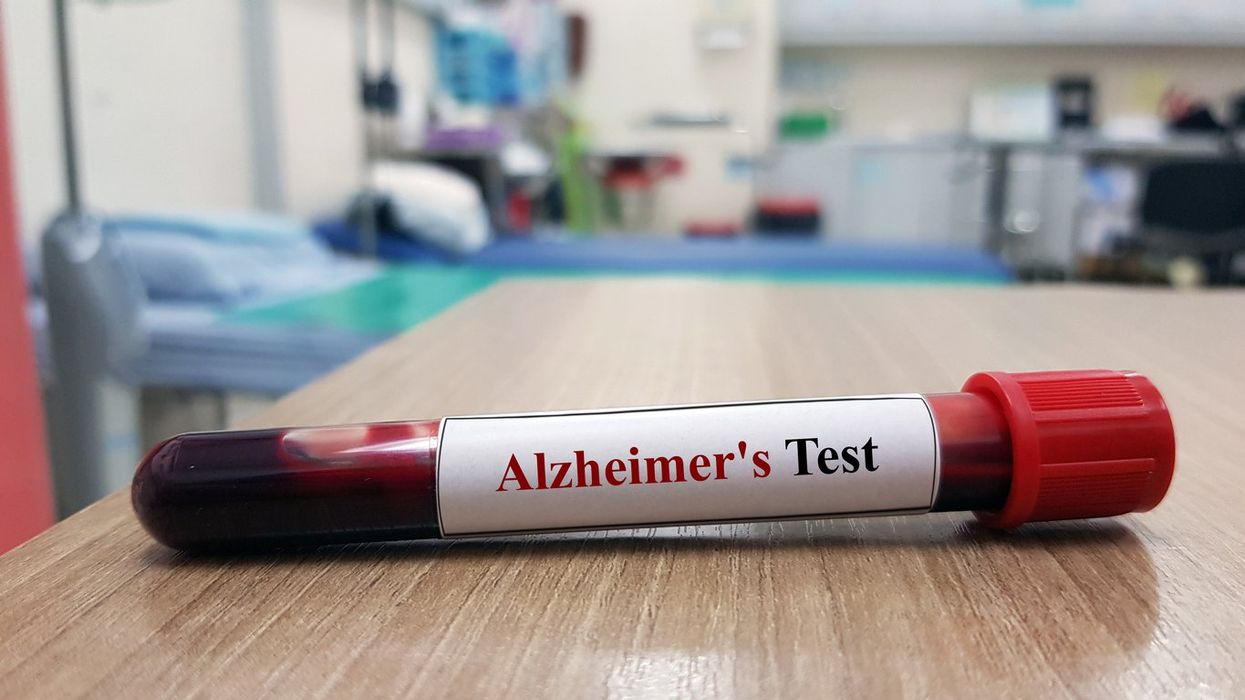 Laboratory sample of blood testing for diagnosis Alzheimer's disease