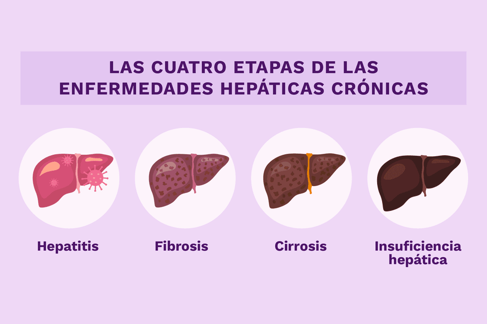 las cuatro etapas de las enfermedades hepaticas cronicas